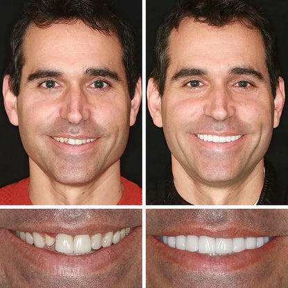 Ends Today: 70% OFF!  🏆2026 Bestselling Product🦷 Fit for a Fresh Smile, Say Goodbye to Wearing Discomfort!🌎