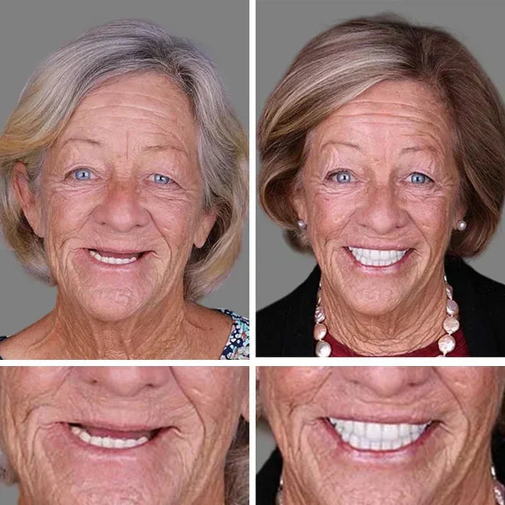 Ends Today: 70% OFF!  🏆2026 Bestselling Product🦷 Fit for a Fresh Smile, Say Goodbye to Wearing Discomfort!🌎