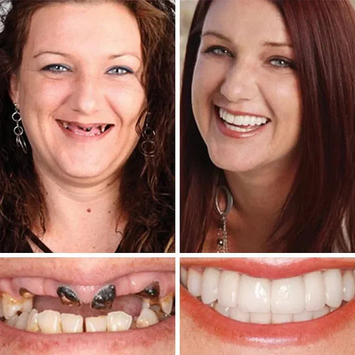 Ends Today: 70% OFF!  🏆2026 Bestselling Product🦷 Fit for a Fresh Smile, Say Goodbye to Wearing Discomfort!🌎